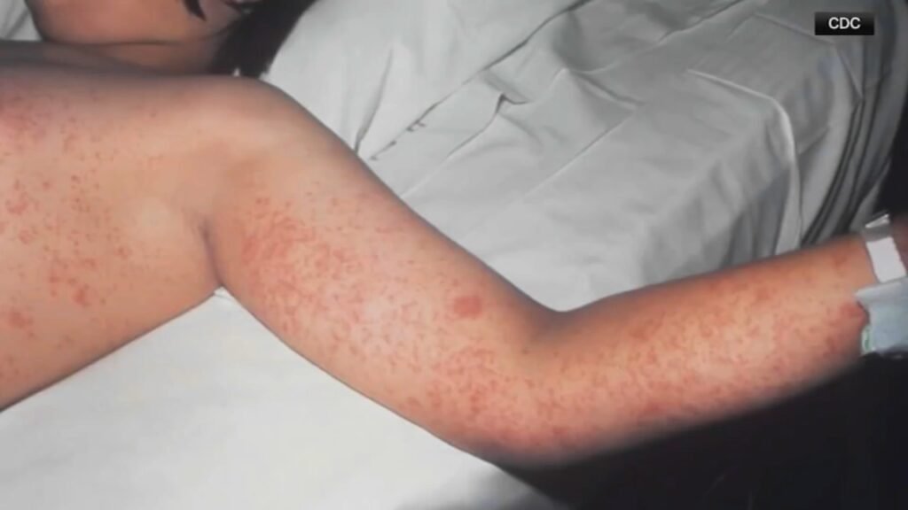 Pennsylvania Measles Cases Surpass 1,000 as New York Declares Disaster Emergency